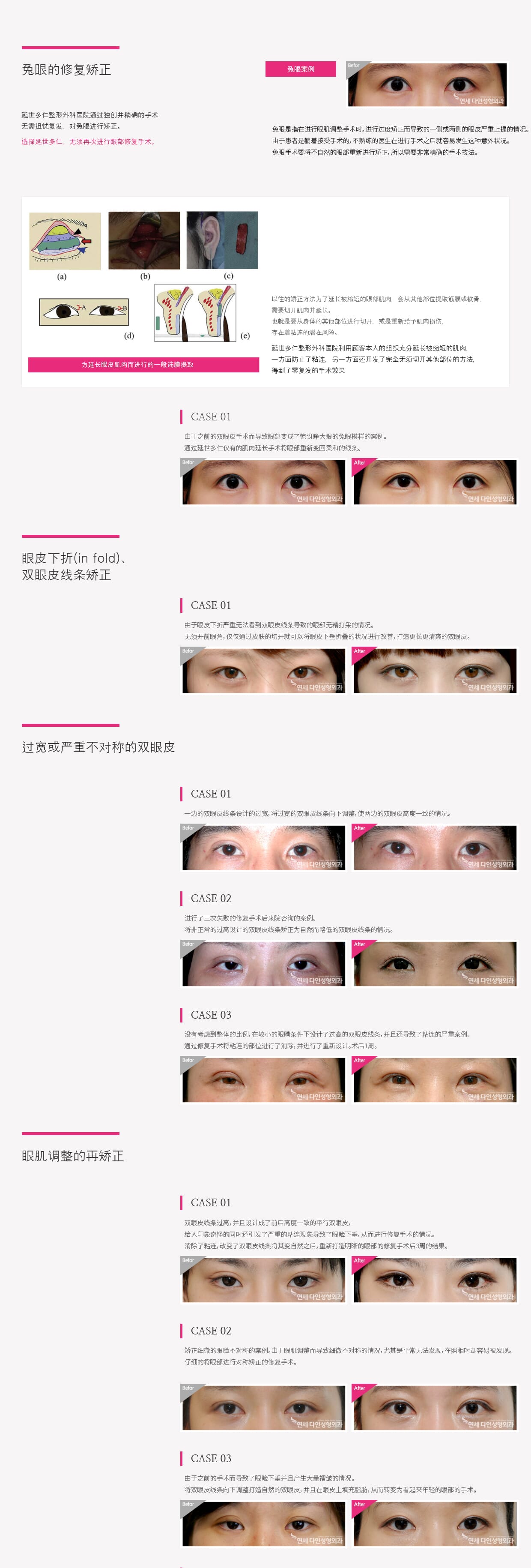 눈재수술