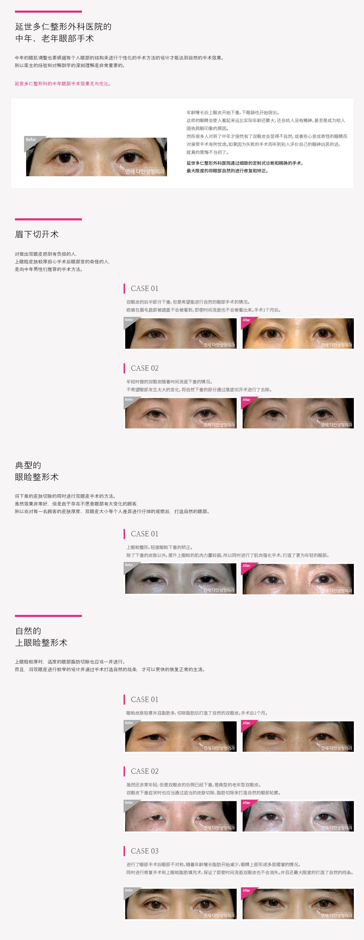 동안눈수술01
