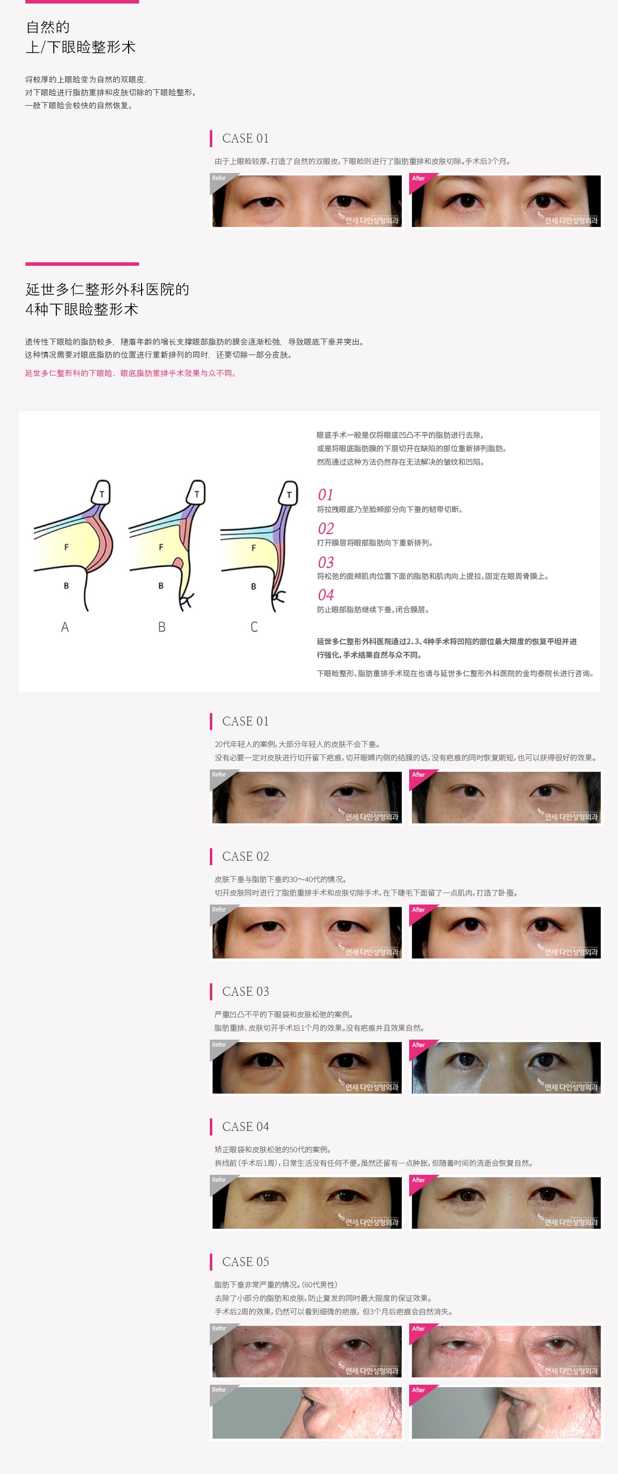 동안눈수술01