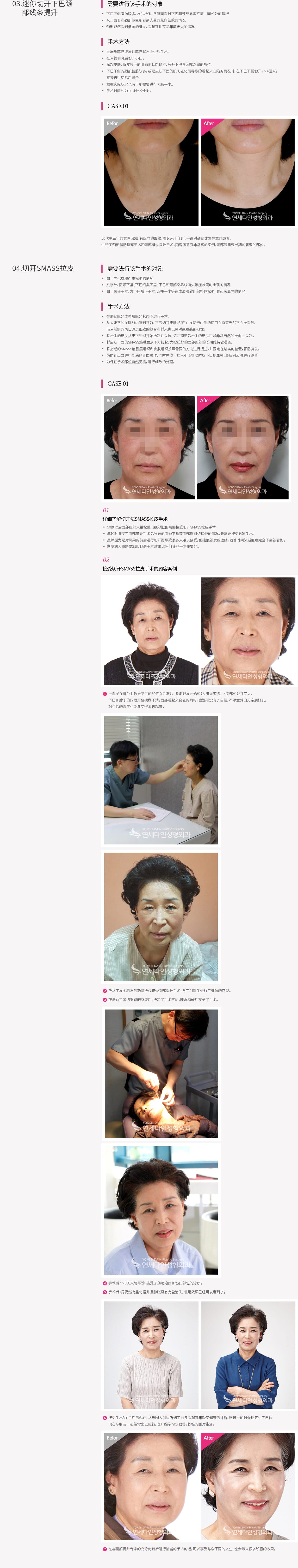 리프팅
